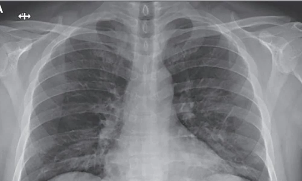 Κοροναϊός: Οδηγός για τον ιό που έχει προκαλέσει παγκόσμια ανησυχία